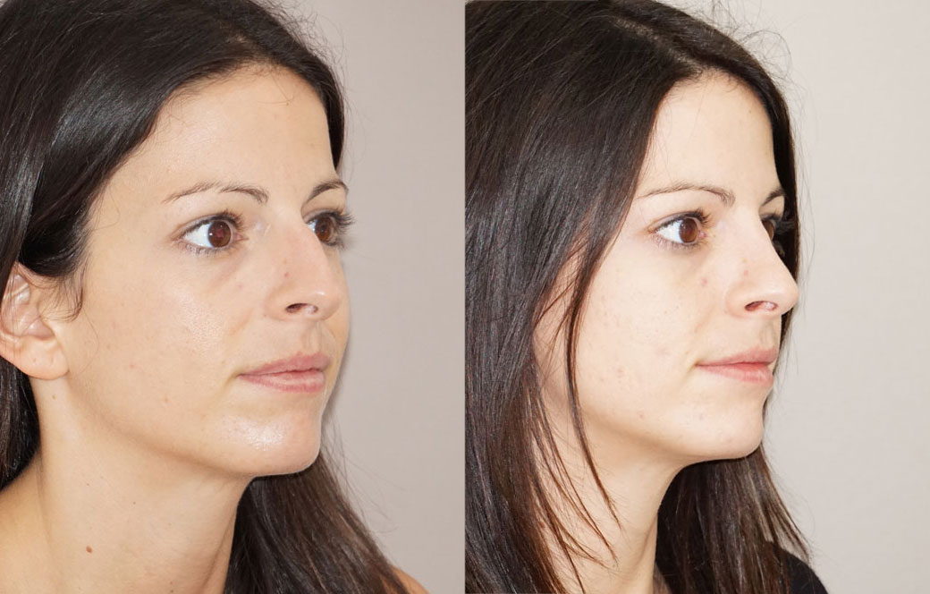 Nose correction surgery Before & after 04 | Ocean Clinic Marbella