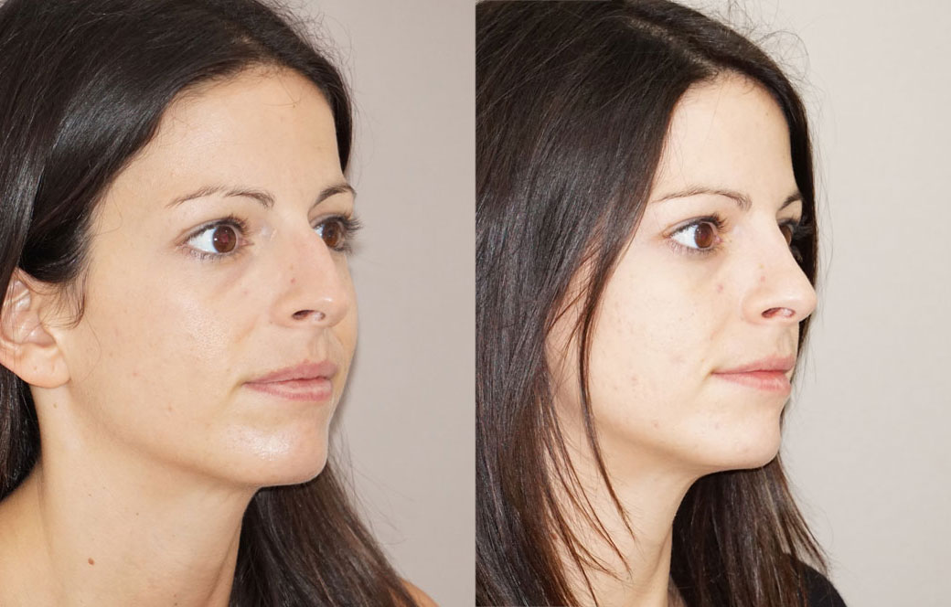 Nose correction surgery Before & after 01 | Ocean Clinic Marbella