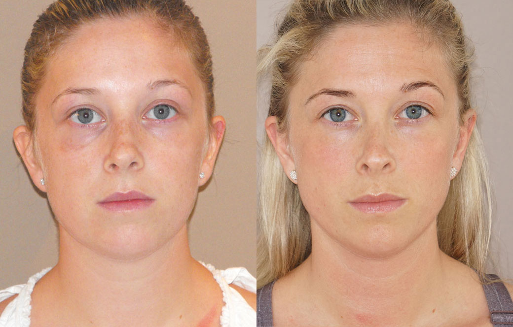 Cirugía de la nariz Antes y después 02 | Ocean Clinic Marbella