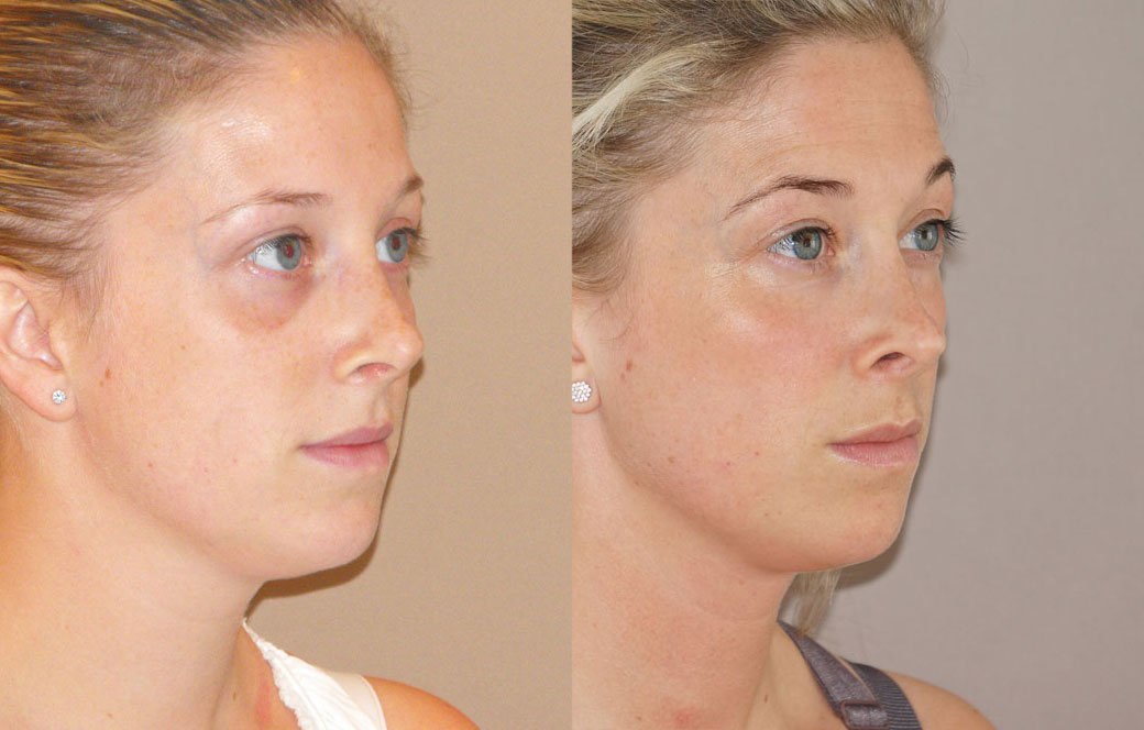 Nose correction surgery Before & after 03 | Ocean Clinic Marbella