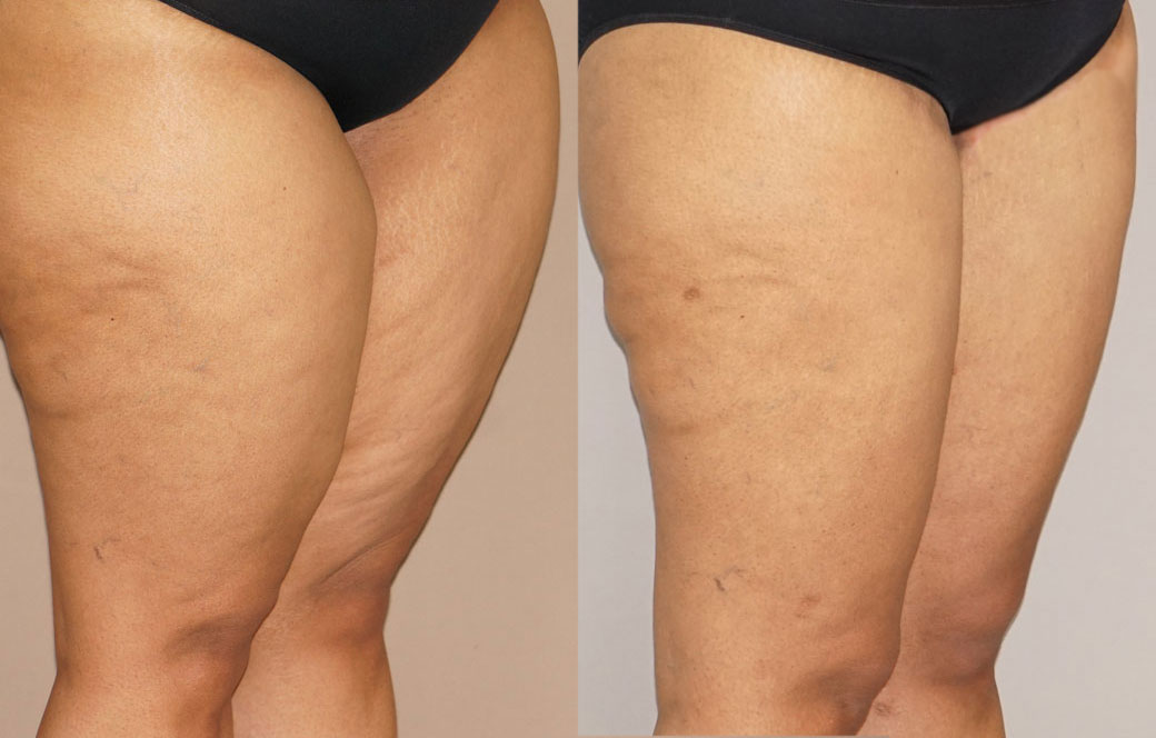 Thigh Lift Before & after 01 | Ocean Clinic Marbella