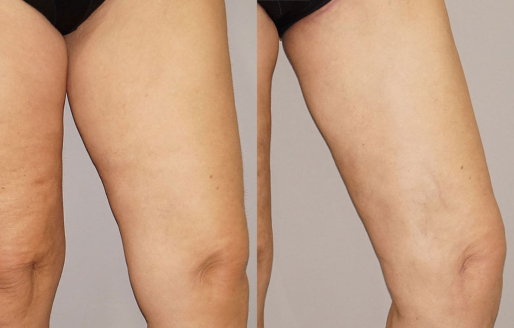 Thigh Lift Before & after 02 | Ocean Clinic Marbella