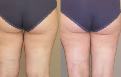 Before & After Gallery Thigh Lift (Thighplasty) 03 | Ocean Clinic Marbella