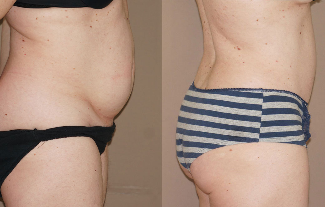 Abdominoplastia - Reducción de abdomen Antes y después 04 | Ocean Clinic Marbella