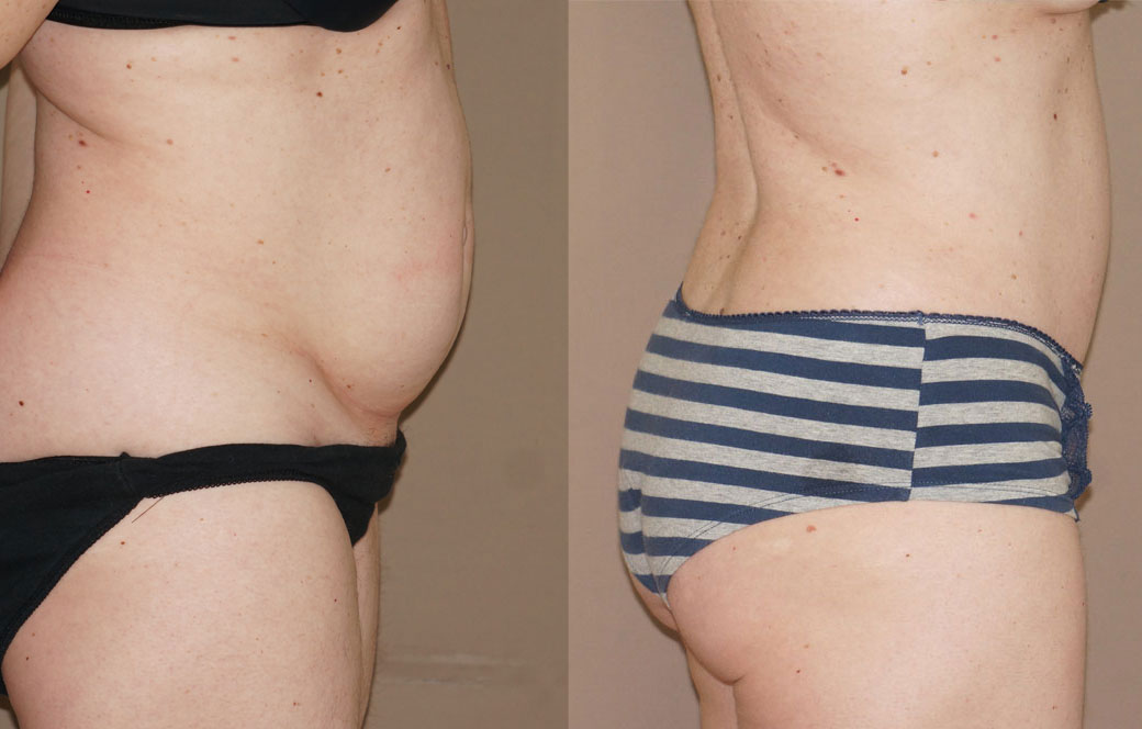 Tummy Tuck - Abdominoplasty Before & after 01 | Ocean Clinic Marbella