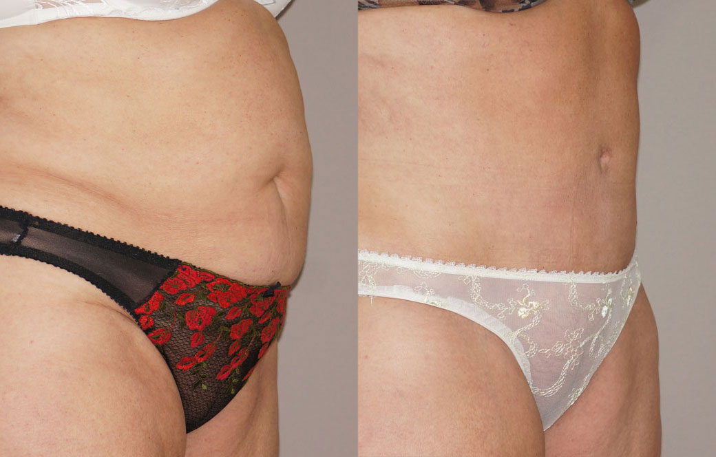 Abdominoplastia - Reducción de abdomen Antes y después 02 | Ocean Clinic Marbella