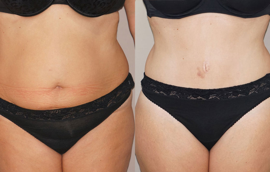 Abdominoplastia - Reducción de abdomen Antes y después 03 | Ocean Clinic Marbella