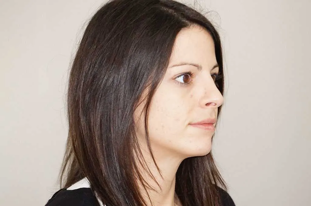 Resultado después de rinoplastia –  vista 3/4