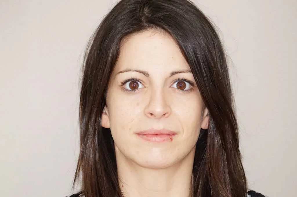 Resultado después de rinoplastia – vista frontal