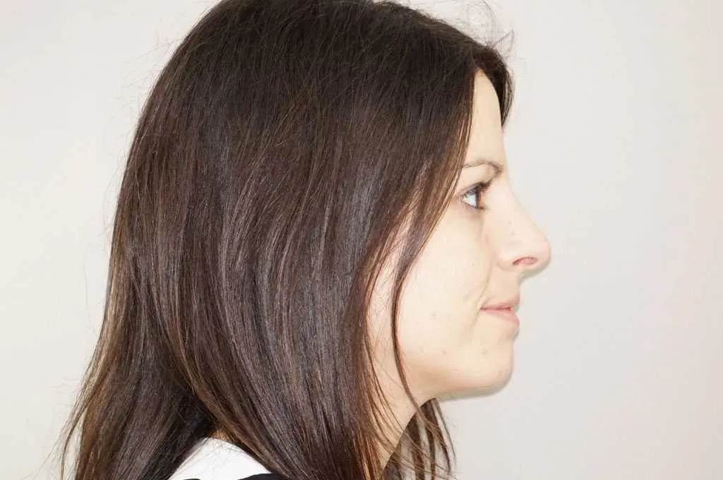 Resultado después de rinoplastia – vista lateral