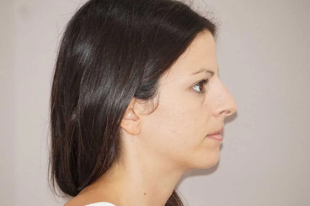 Rinoplastia antes de la cirugía – vista lateral