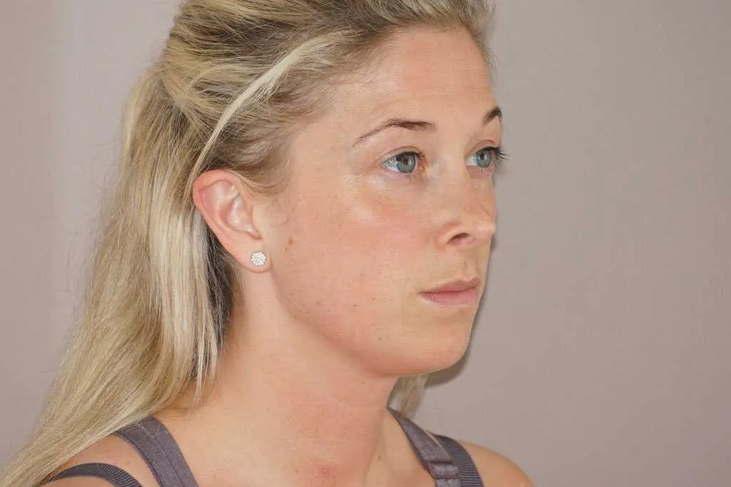 Resultado después de rinoplastia –  vista 3/4