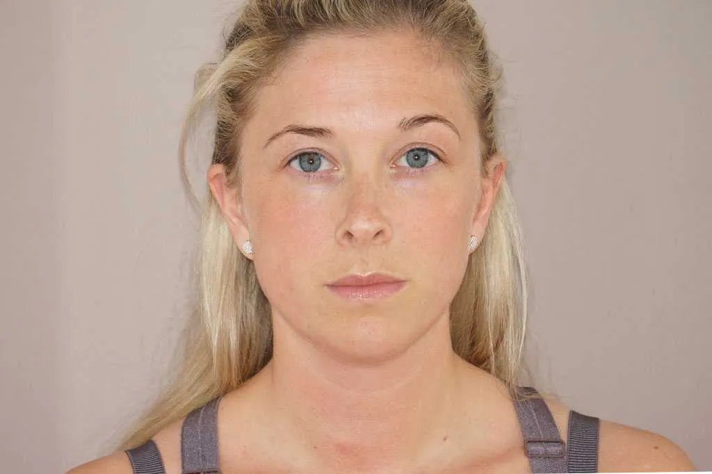 Resultado después de rinoplastia – vista frontal