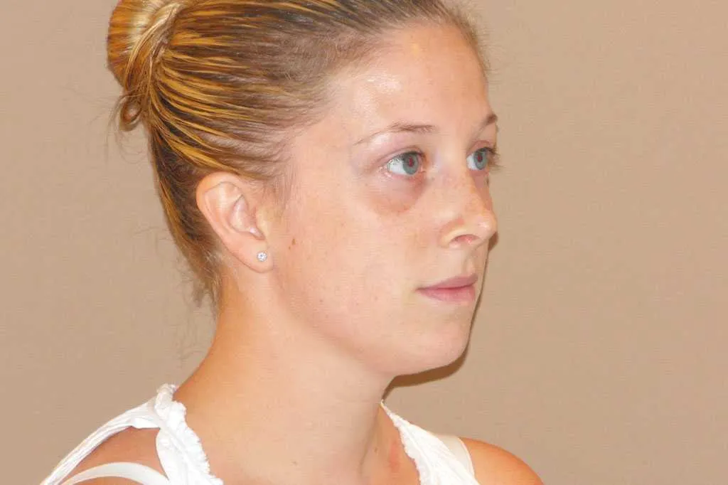 Rinoplastia antes de la cirugía – vista 3/4