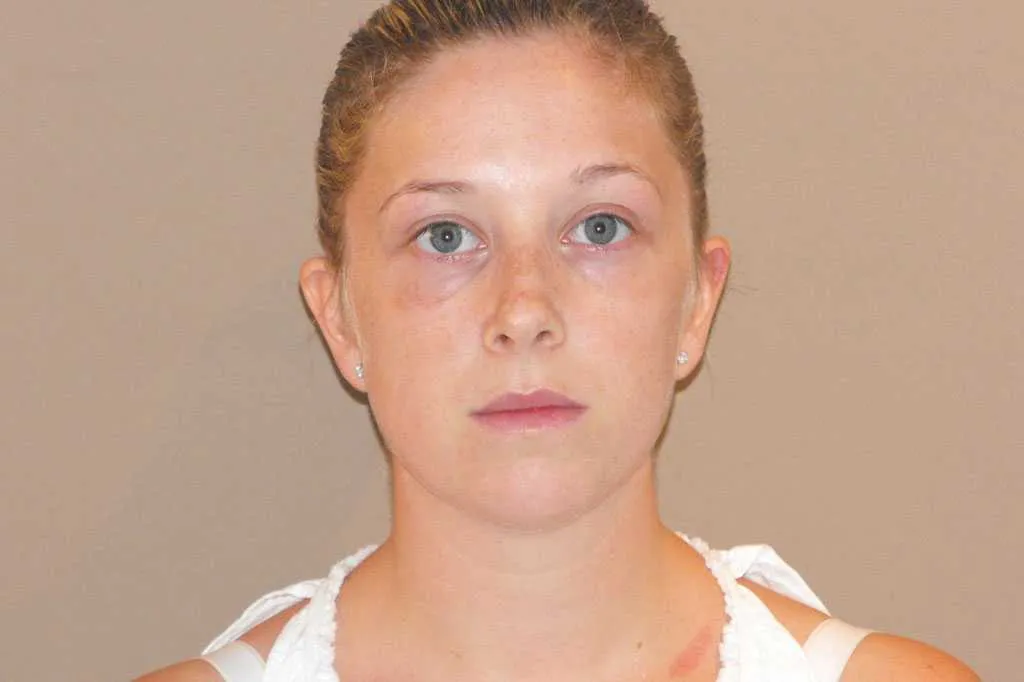 Rinoplastia en Marbella antes de la cirugía – vista frontal