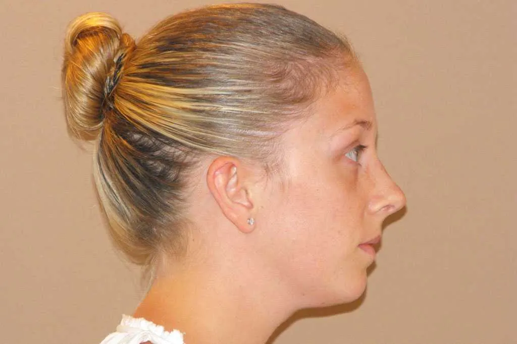 Rinoplastia antes de la cirugía – vista lateral