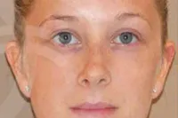 Caso real rinoplastia Marbella - 02