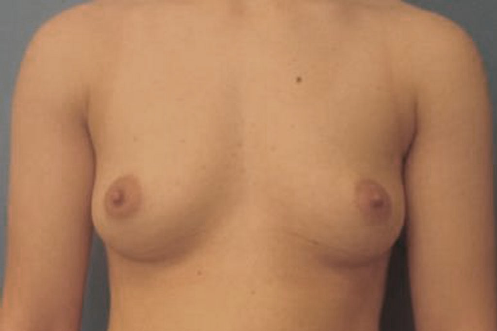 Female to male Mastectomy Before & after photos 01