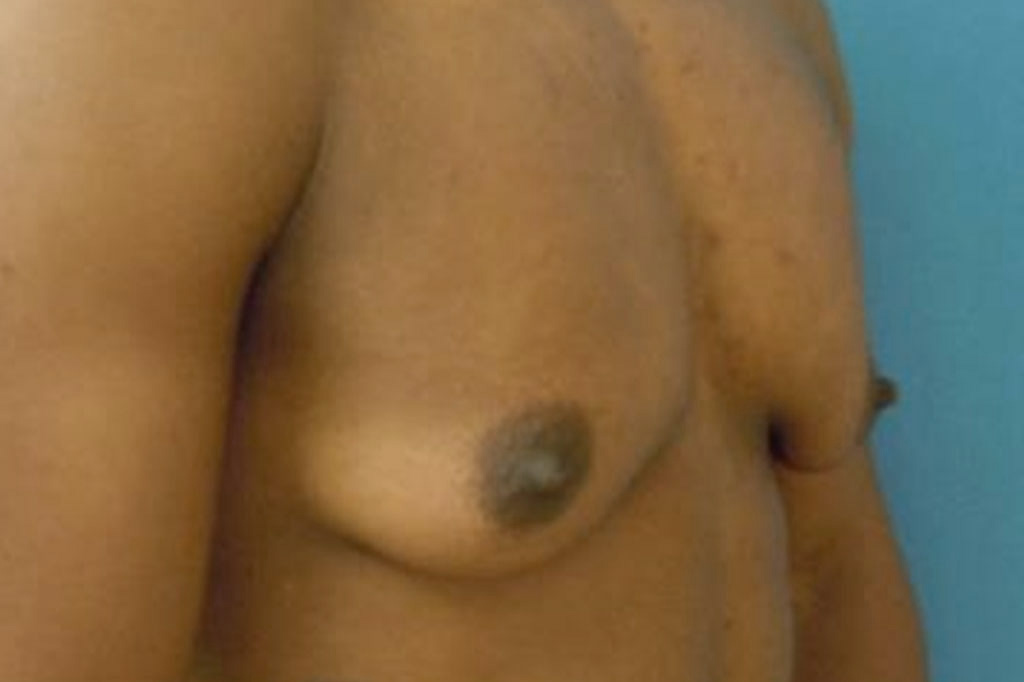 Female to male Mastectomy Before & after photos 03