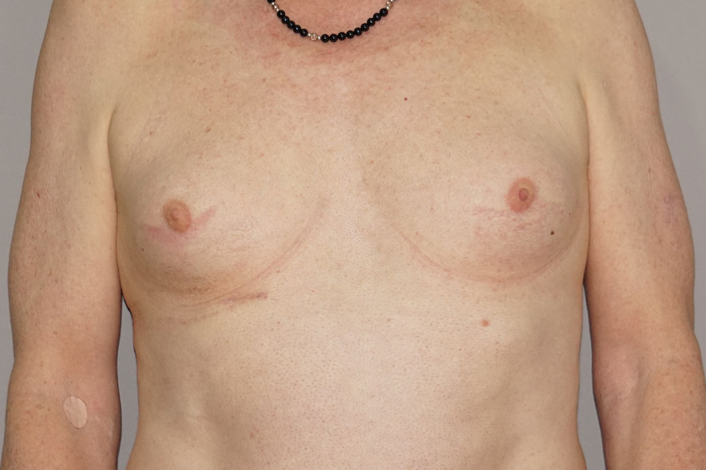 Male to female Breast augmentation case03 Before & after photos 01