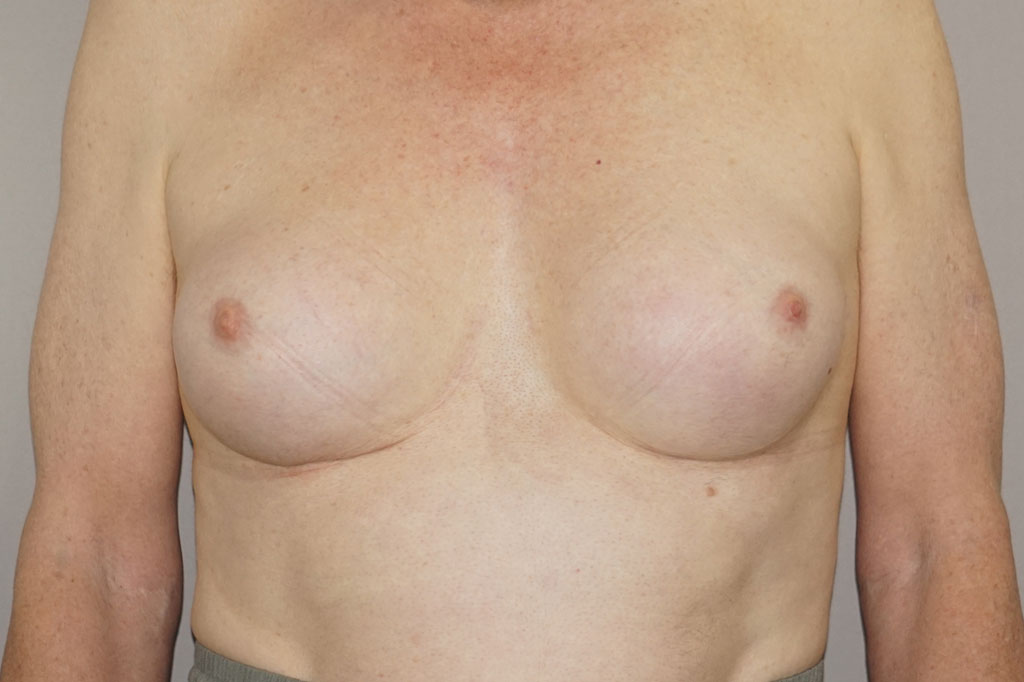 Male to female Breast augmentation case03 Before & after photos 02