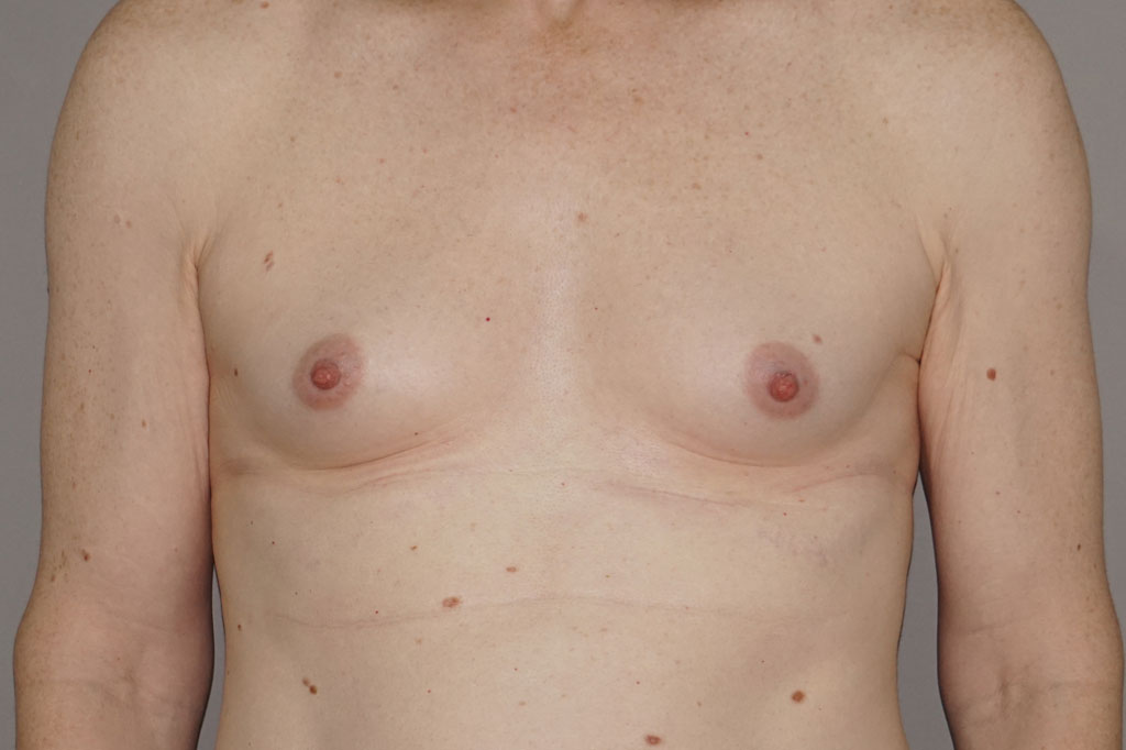 Male to female Breast augmentation case05 Before & after photos 01