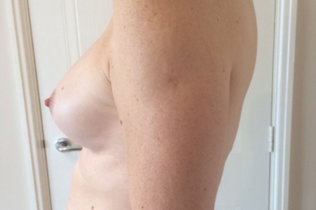 Male to female Breast augmentation case05 Before & after photos 04