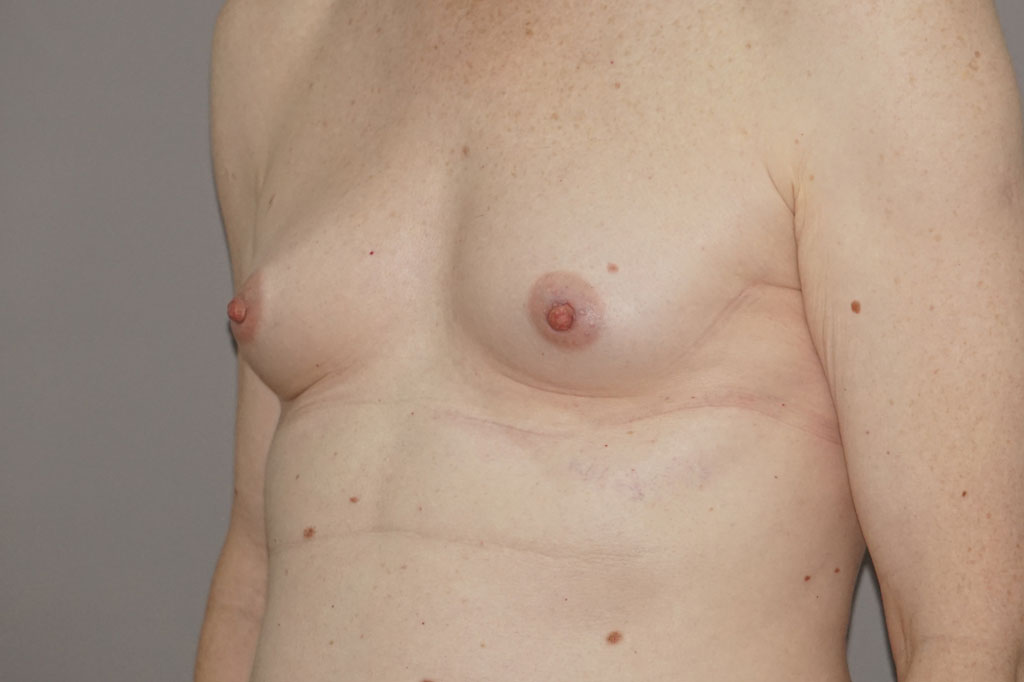 Male to female Breast augmentation case05 Before & after photos 05
