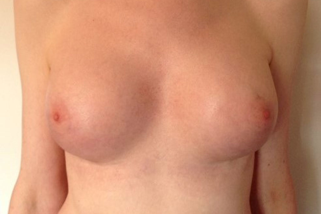 Male to female Breast augmentation case06 Before & after photos 02