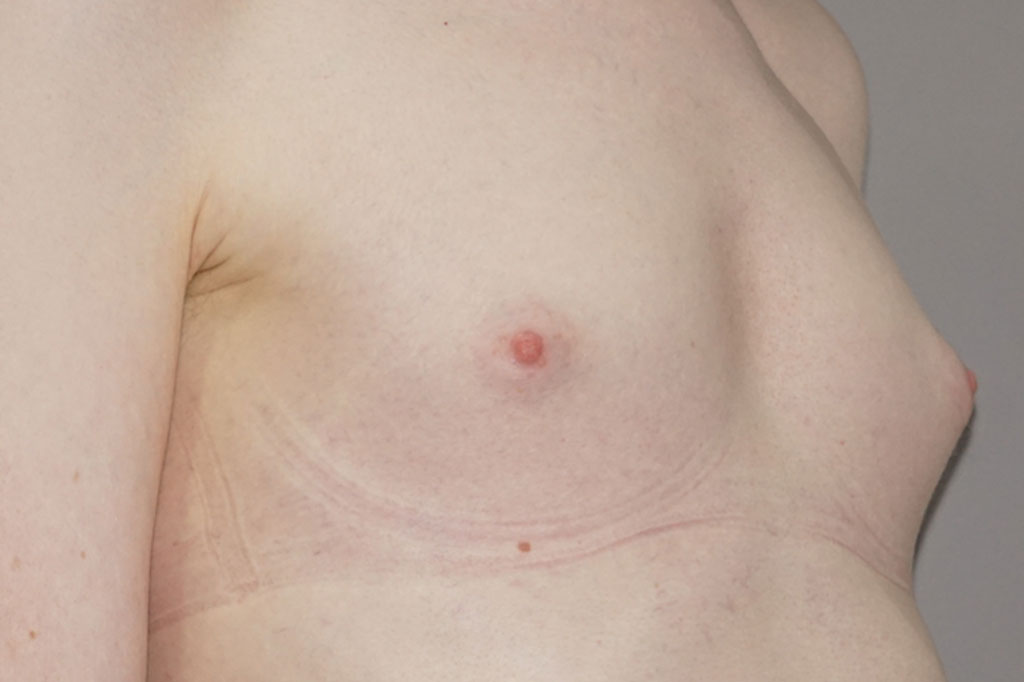 Male to female Breast augmentation case06 Before & after photos 03