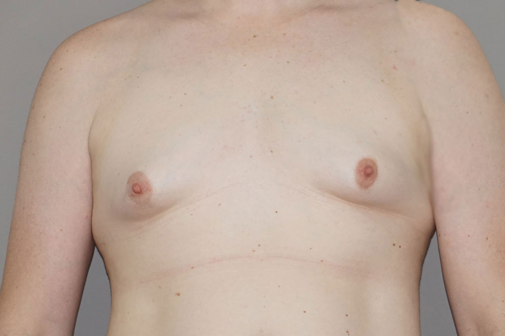 Male to female Breast augmentation case02 Before & after photos 01