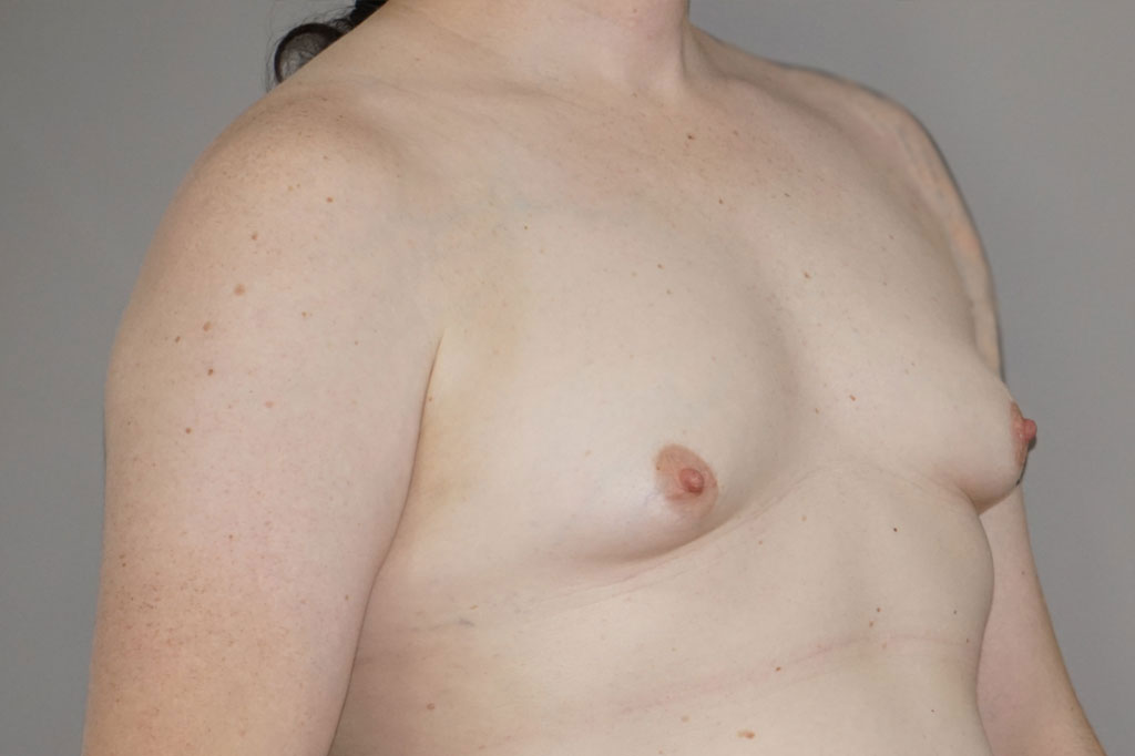 Male to female Breast augmentation case02 Before & after photos 03