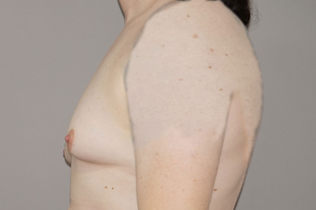 Male to female Breast augmentation case02 Before & after photos 05