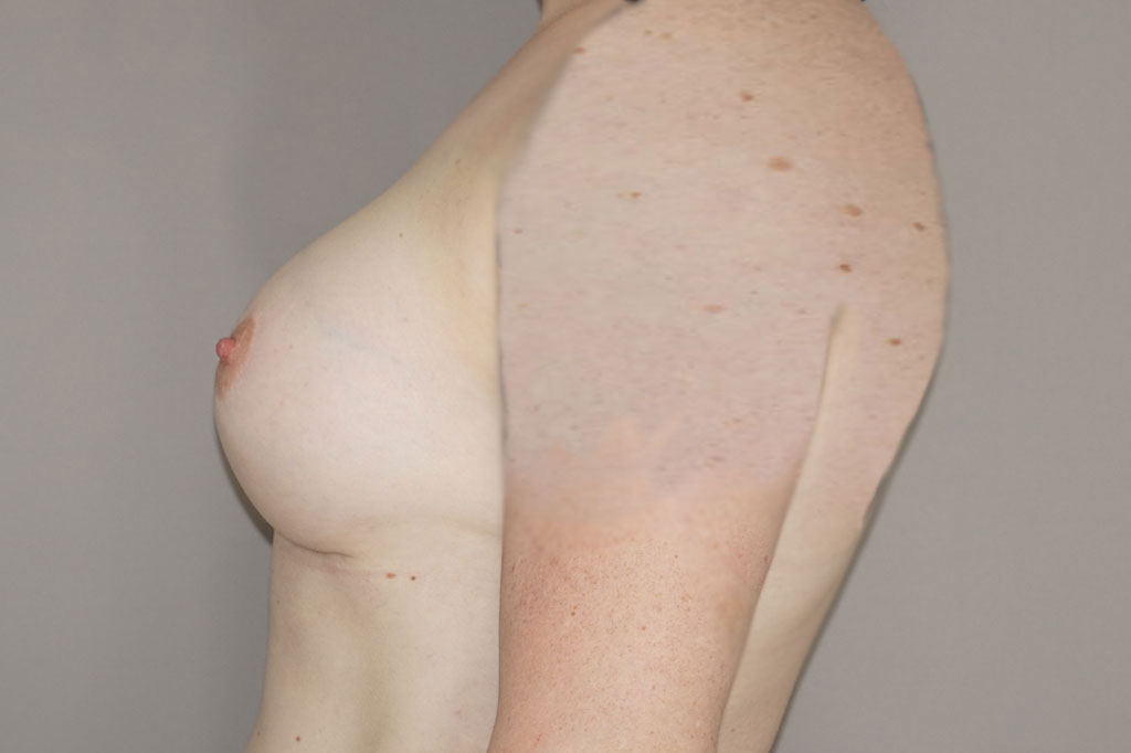 Male to female Breast augmentation case02 Before & after photos 06