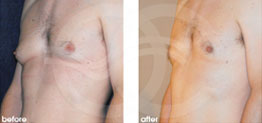 Gynecomastia Before and After 02