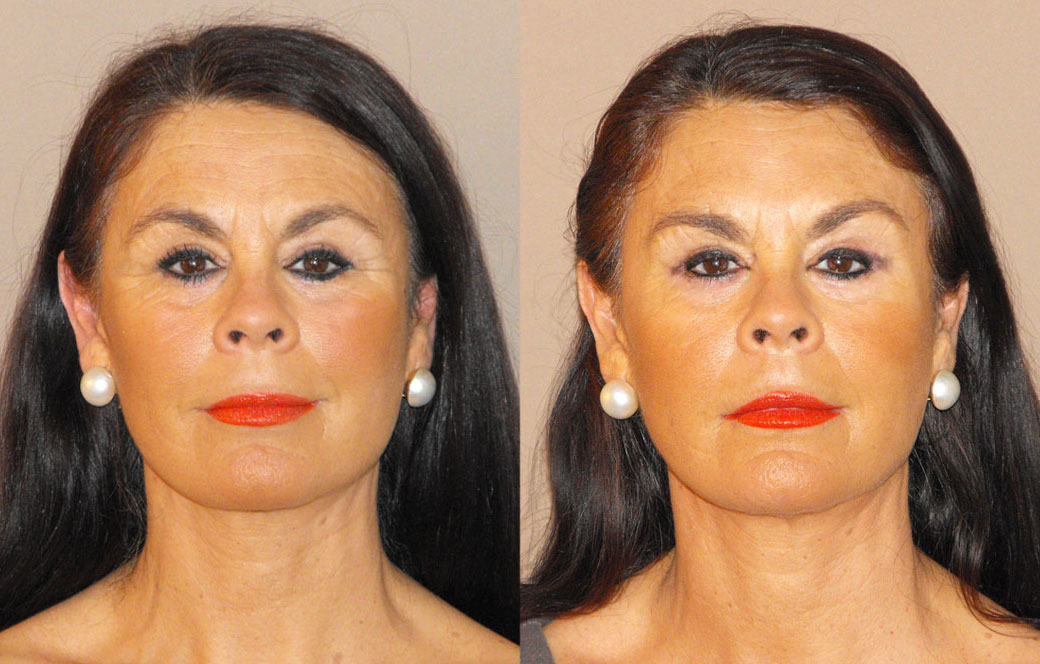 Chemical denervation Before & after 01 | Ocean Clinic Marbella