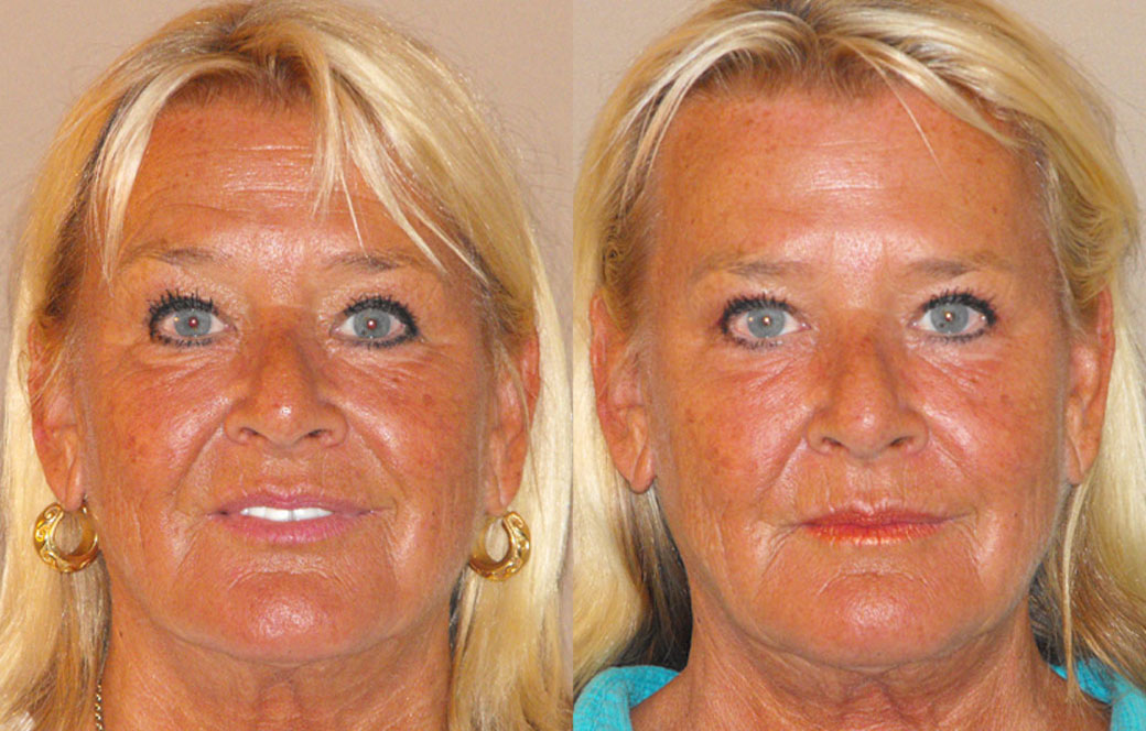 Chemical denervation Before & after 03 | Ocean Clinic Marbella