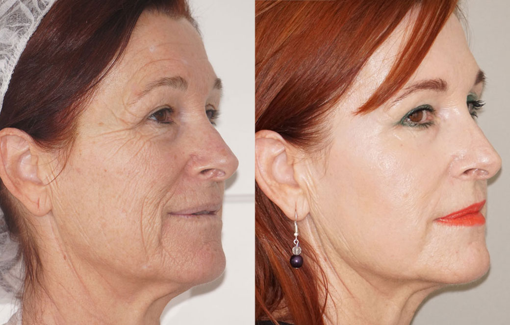 Chemical Peels Before & after 01 | Ocean Clinic Marbella