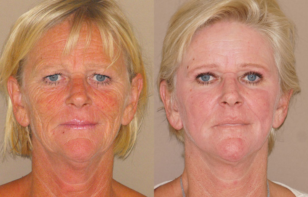 Chemical Peels Before & after 02 | Ocean Clinic Marbella