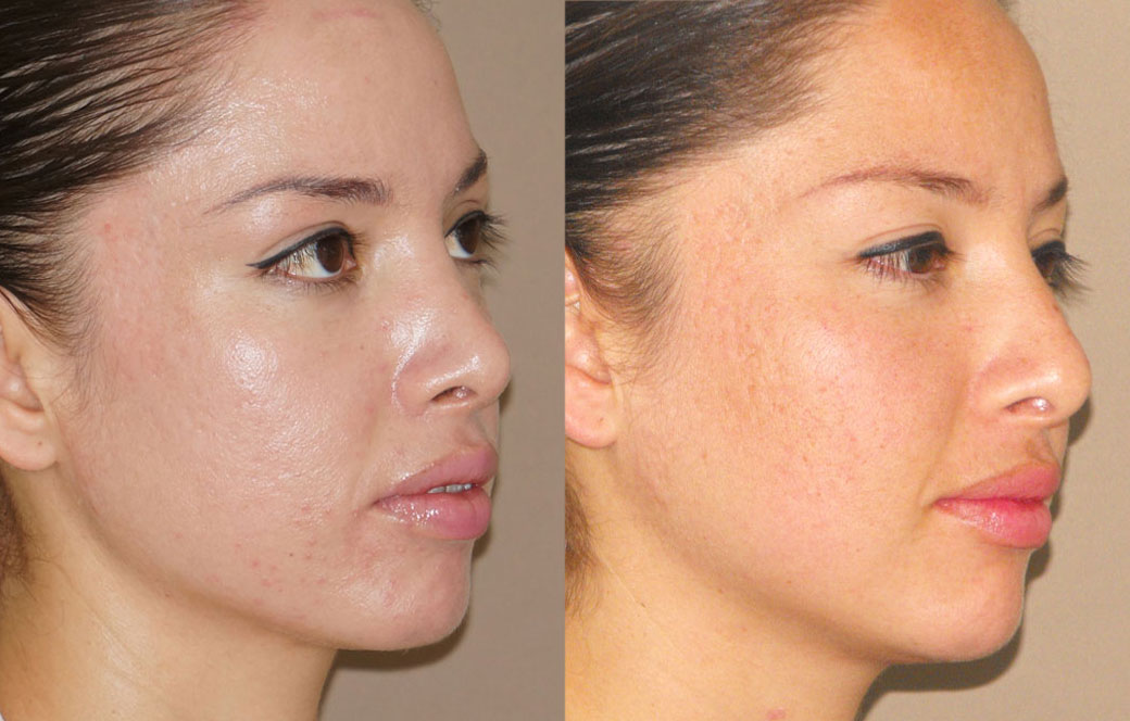 Peeling profundo Antes y después 03 | Ocean Clinic Marbella