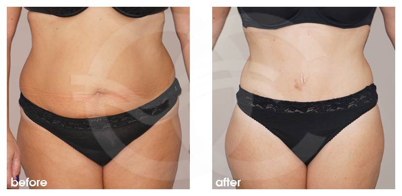 Tummy tuck Abdominoplasty - before and after real clinical case 03