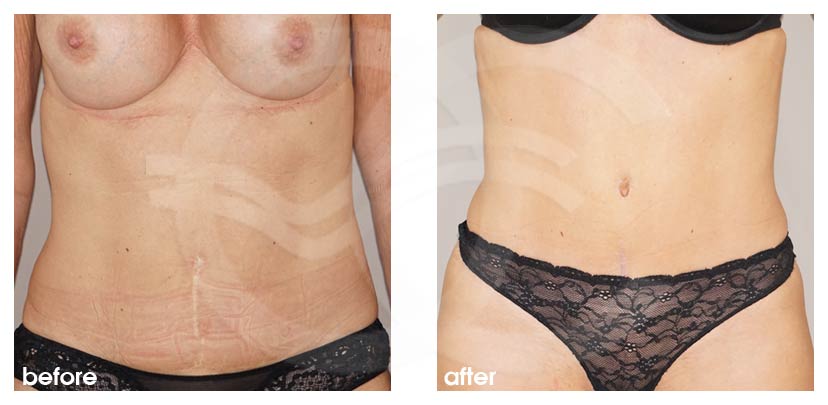 Tummy tuck Abdominoplasty - before and after real clinical case 02