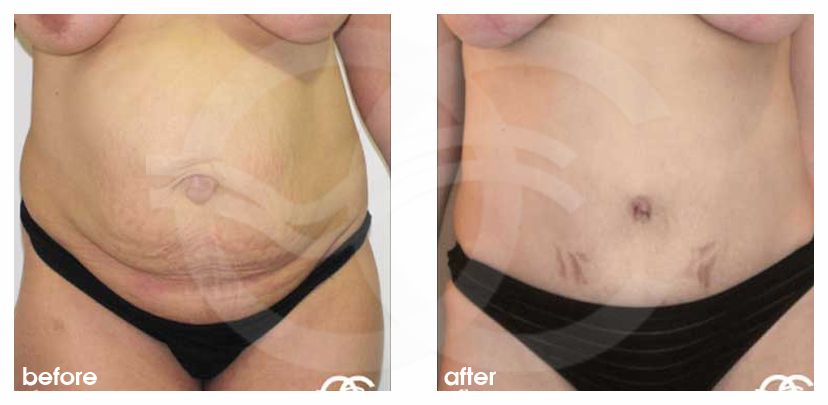 Abdominoplastie 10 ante/post-op profil