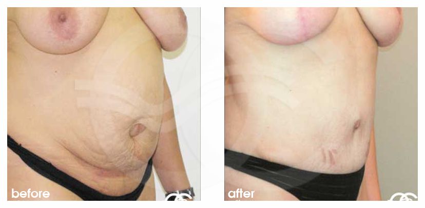 Abdominoplastie 10 ante/post-op lateral