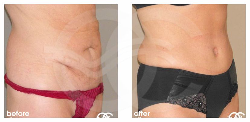 Abdominoplastie 11 ante/post-op lateral