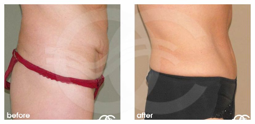 Abdominoplastie 11 ante/post-op retro/lateral