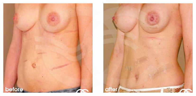 Abdominoplastie 12 ante/post-op lateral