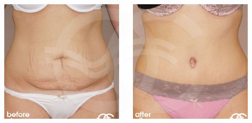 Abdominoplastie 14 ante/post-op profil