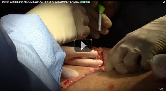 Bauchdeckenstraffung OP-Video. Ocean Clinic Marbella